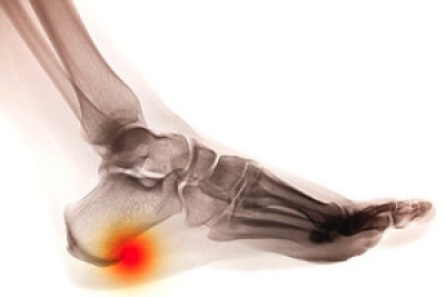 2 Common Types of Heel Spurs