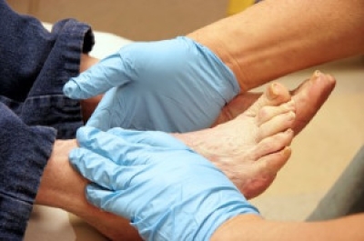 Foot Problems From Diabetic Patients